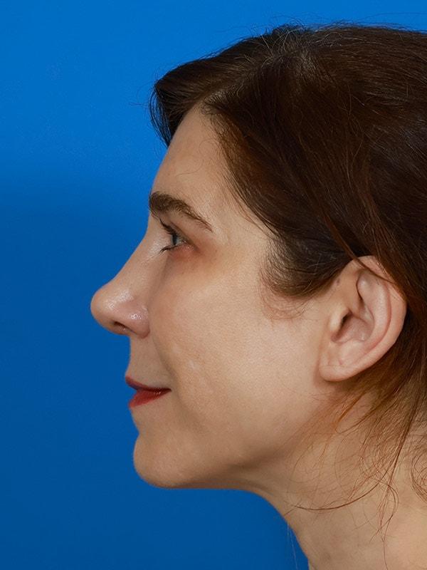 Renata Facial Cosmetic Surgery (Renata Khelemsky, MD) rhinoplasty after — Brooklyn, NY