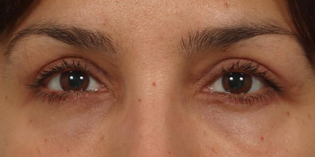 Blepharoplasty after at Renata Facial Cosmetic Surgery (Renata Khelemsky, MD) in Brooklyn, NY