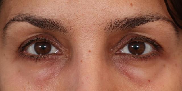 Blepharoplasty before at Renata Facial Cosmetic Surgery (Renata Khelemsky, MD) in Brooklyn, NY