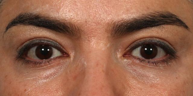 Blepharoplasty before at Renata Facial Cosmetic Surgery (Renata Khelemsky, MD) in Brooklyn, NY