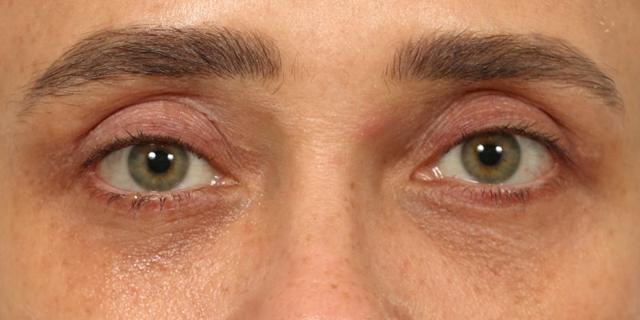 Blepharoplasty after at Renata Facial Cosmetic Surgery (Renata Khelemsky, MD) in Brooklyn, NY