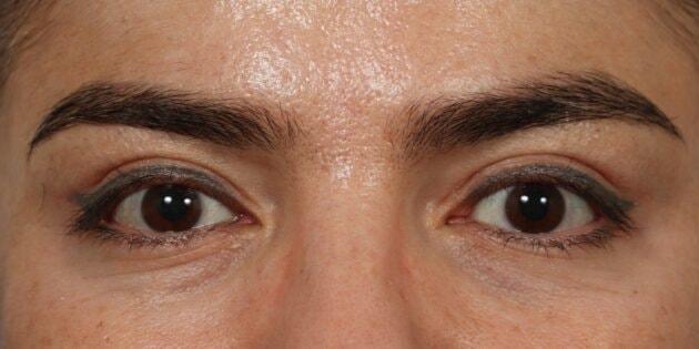 Blepharoplasty after at Renata Facial Cosmetic Surgery (Renata Khelemsky, MD) in Brooklyn, NY