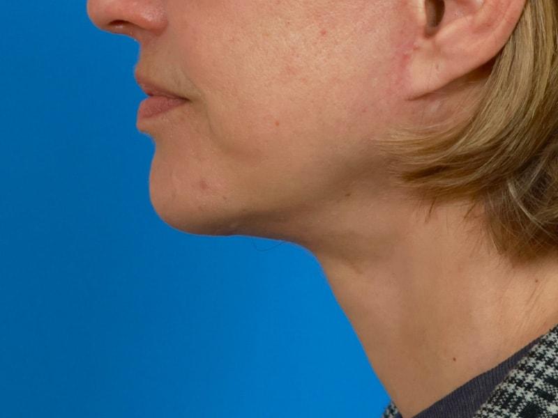 Renata Facial Cosmetic Surgery (Renata Khelemsky, MD) chin implant after — Brooklyn, NY
