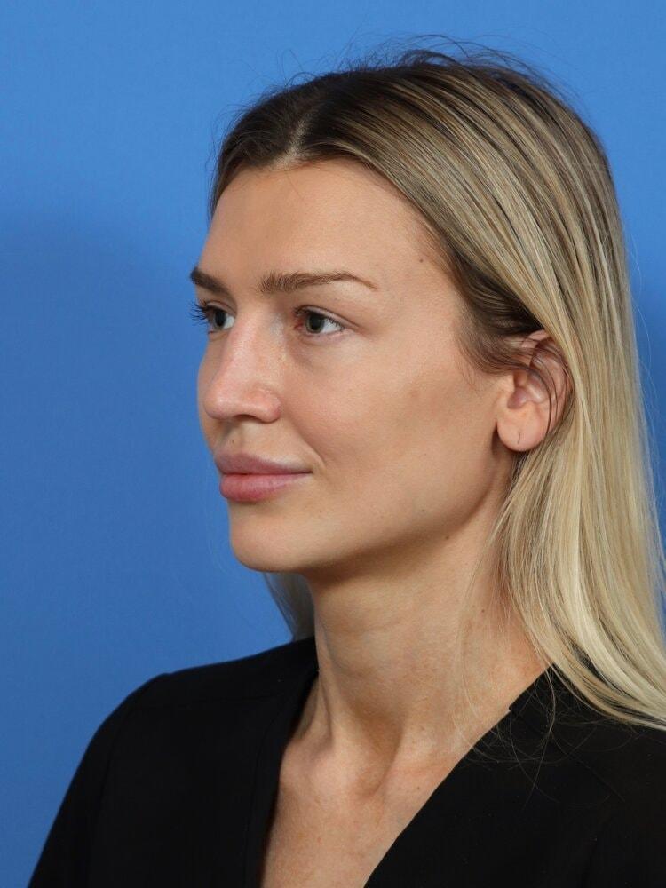 Renata Facial Cosmetic Surgery (Renata Khelemsky, MD) rhinoplasty after — Brooklyn, NY