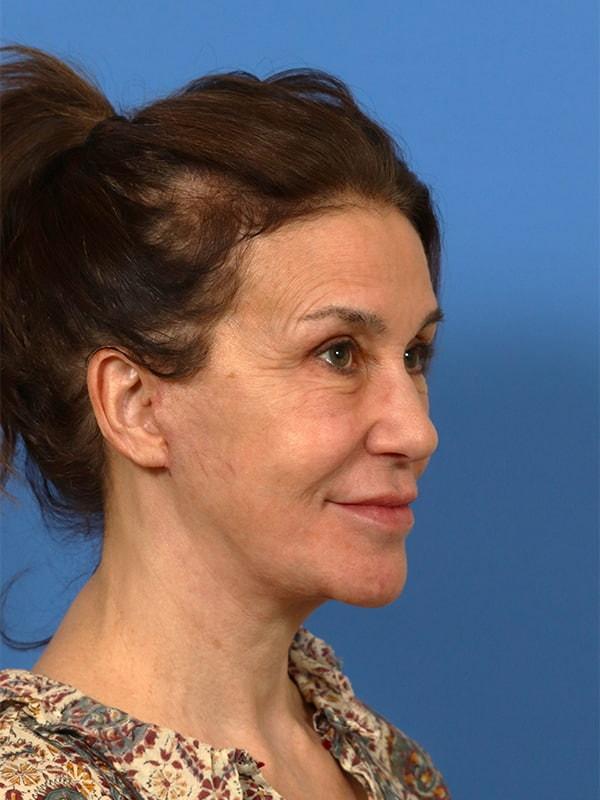 Renata Facial Cosmetic Surgery (Renata Khelemsky, MD) facelift after — Brooklyn, NY