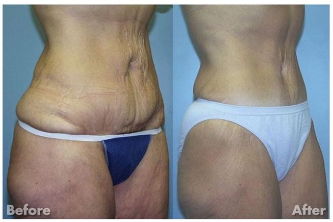 Kirk A. Churukian MD FACS tummy tuck result — Los Gatos, CA