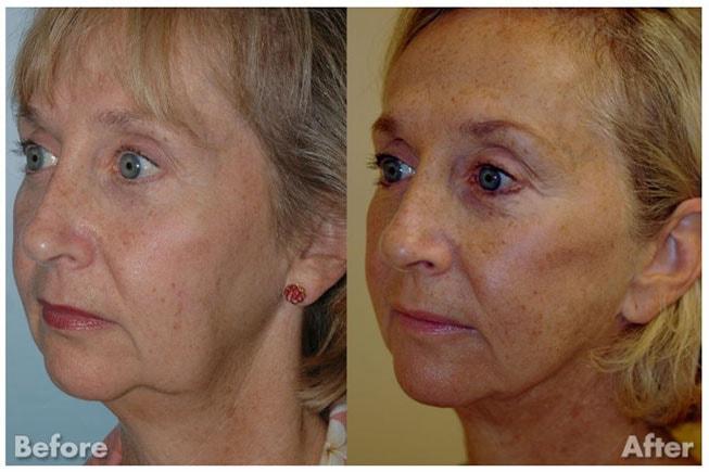 Kirk A. Churukian MD FACS facelift result — Los Gatos, CA