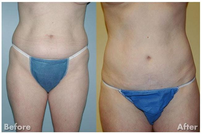 Kirk A. Churukian MD FACS tummy tuck result — Los Gatos, CA