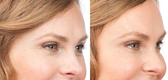 Botox result at Kirk A. Churukian MD FACS in Los Gatos, CA