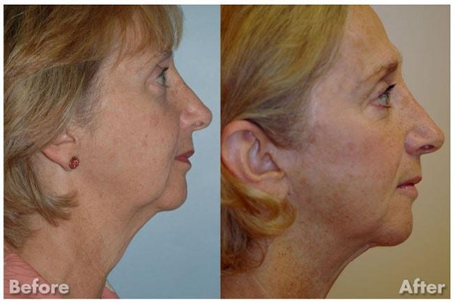Kirk A. Churukian MD FACS facelift result — Los Gatos, CA