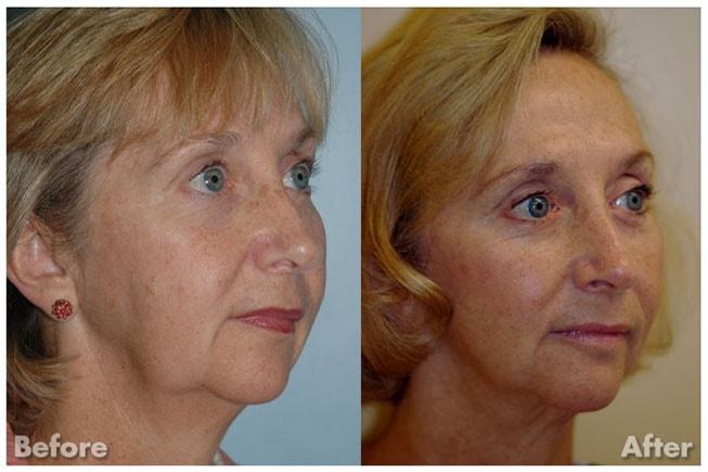 Kirk A. Churukian MD FACS facelift result — Los Gatos, CA