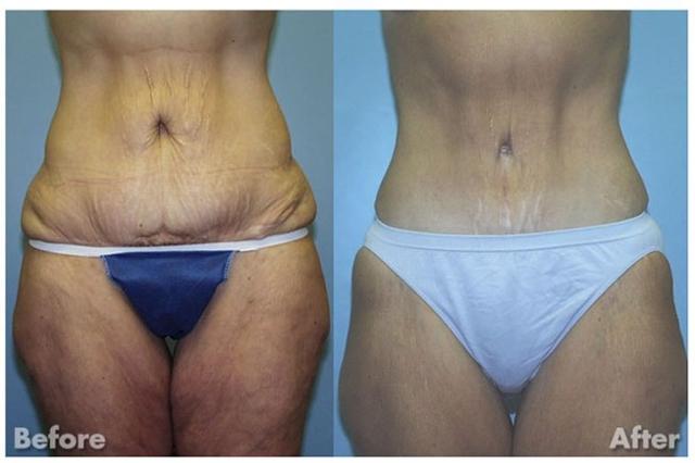 Mini Tummy Tuck result at Kirk A. Churukian MD FACS in Los Gatos, CA