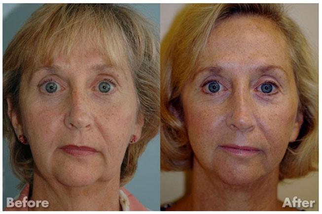 Kirk A. Churukian MD FACS facelift result — Los Gatos, CA
