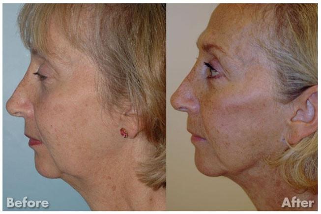 Kirk A. Churukian MD FACS facelift result — Los Gatos, CA
