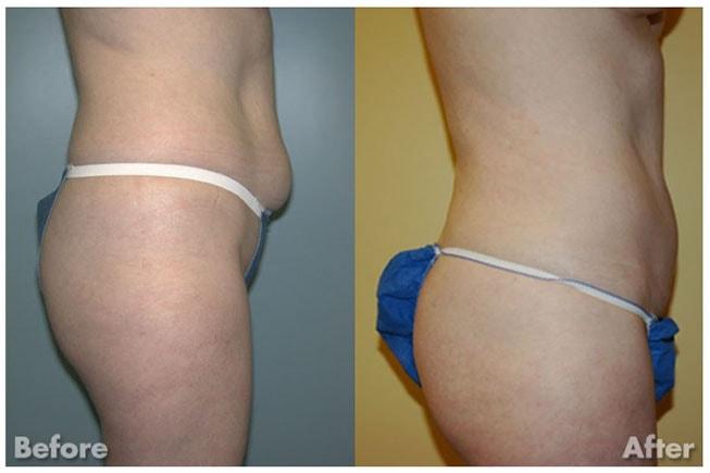 Kirk A. Churukian MD FACS tummy tuck result — Los Gatos, CA