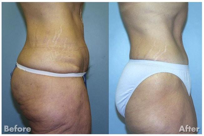 Kirk A. Churukian MD FACS tummy tuck result — Los Gatos, CA
