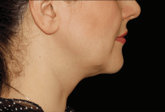 Jiva Med Spa Columbus after — Columbus, OH