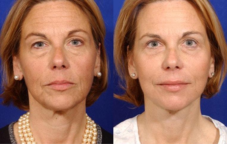 Brent Moelleken, MD neck lift result — Beverly Hills, CA