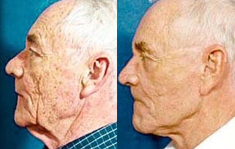 Brent Moelleken, MD neck lift result — Beverly Hills, CA