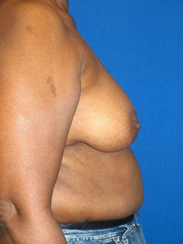 Breast Augmentation before at ARC Plastic Surgery in Miami, FL