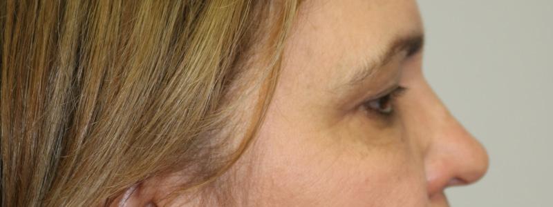 ARC Plastic Surgery brow lift result — Miami, FL
