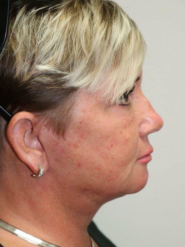 Neck Lift after at ARC Plastic Surgery in Miami, FL