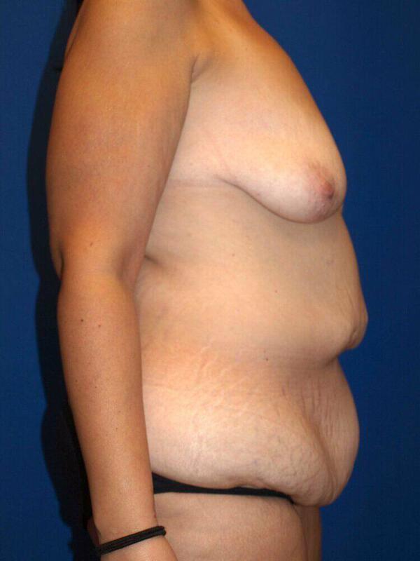 Tummy Tuck before at ARC Plastic Surgery in Miami, FL
