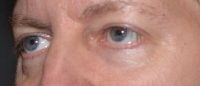 Blepharoplasty after at ARC Plastic Surgery in Miami, FL