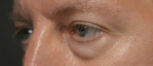 Blepharoplasty before at ARC Plastic Surgery in Miami, FL