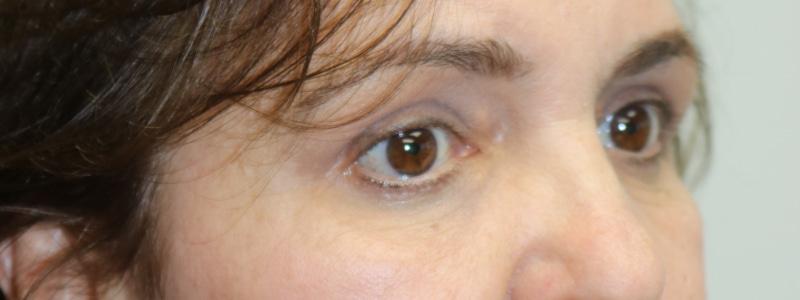 ARC Plastic Surgery brow lift result — Miami, FL