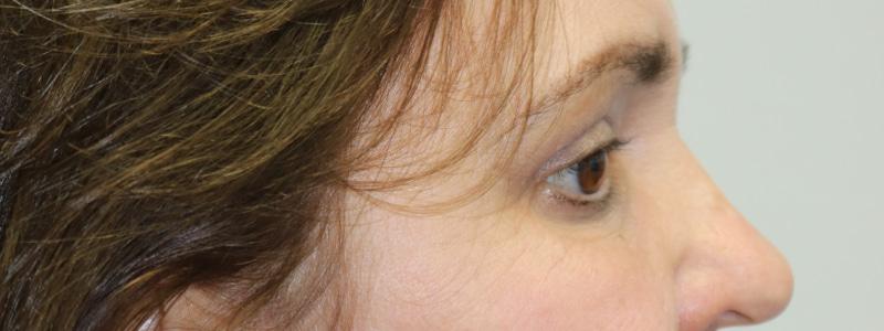 ARC Plastic Surgery brow lift result — Miami, FL