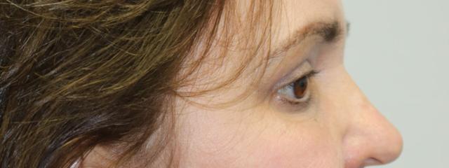 Brow Lift result at ARC Plastic Surgery in Miami, FL