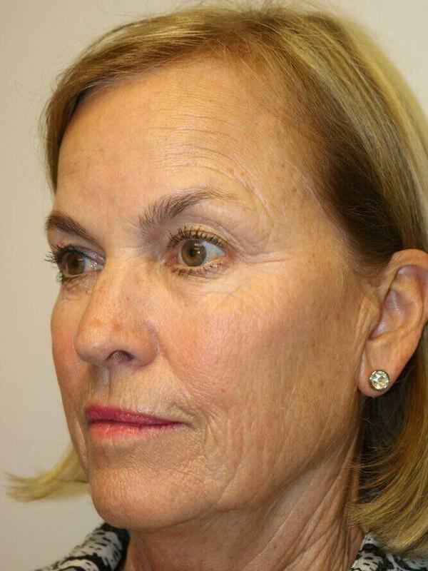 Facelift before at ARC Plastic Surgery in Miami, FL