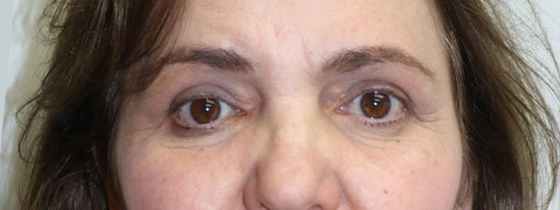 ARC Plastic Surgery brow lift result — Miami, FL
