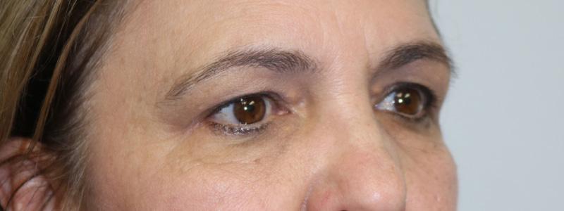 ARC Plastic Surgery brow lift result — Miami, FL