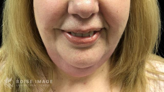 Lip Filler before at Boise Image Enhancement Center, Inc in Boise, ID