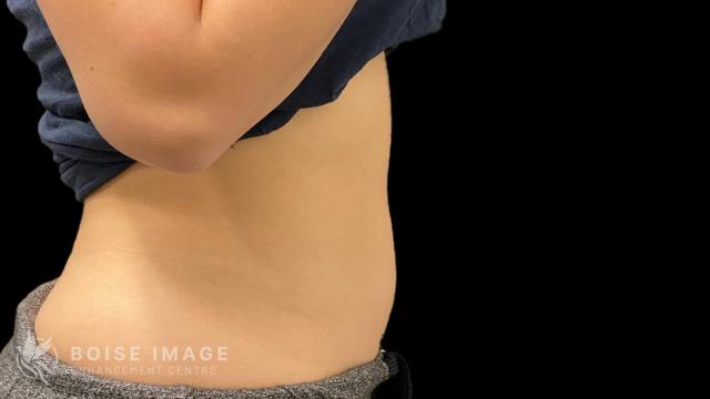Liposuction after at Boise Image Enhancement Center, Inc in Boise, ID
