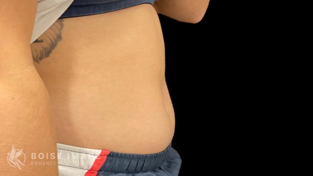 Liposuction before at Boise Image Enhancement Center, Inc in Boise, ID