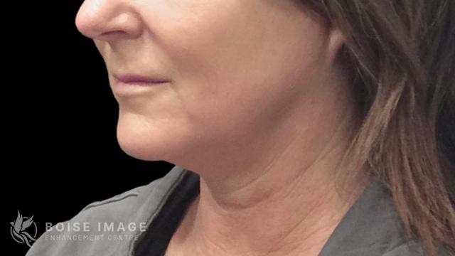 Mini Facelift before at Boise Image Enhancement Center, Inc in Boise, ID