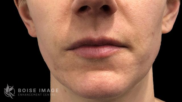 Juvederm before at Boise Image Enhancement Center, Inc in Boise, ID
