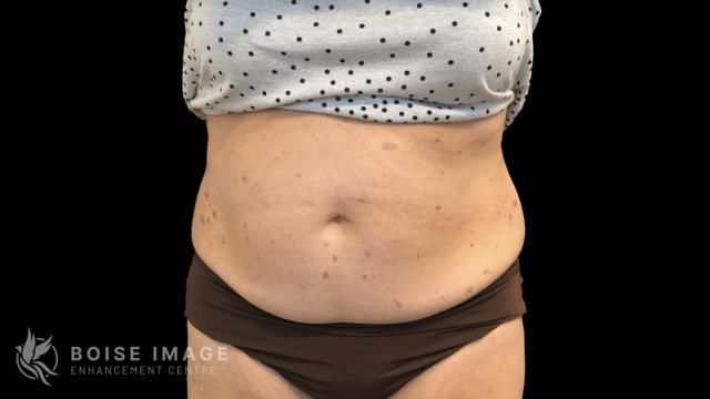 Liposuction after at Boise Image Enhancement Center, Inc in Boise, ID