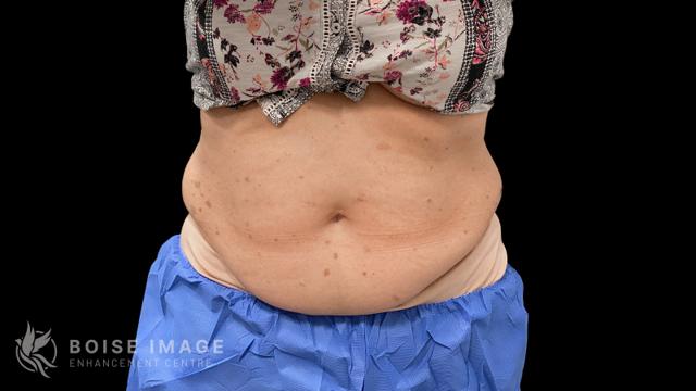 Liposuction before at Boise Image Enhancement Center, Inc in Boise, ID