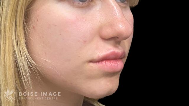 Lip Filler after at Boise Image Enhancement Center, Inc in Boise, ID