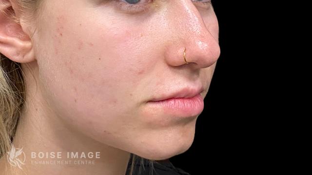 Lip Filler before at Boise Image Enhancement Center, Inc in Boise, ID