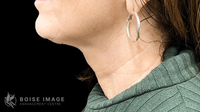 Mini Facelift before at Boise Image Enhancement Center, Inc in Boise, ID