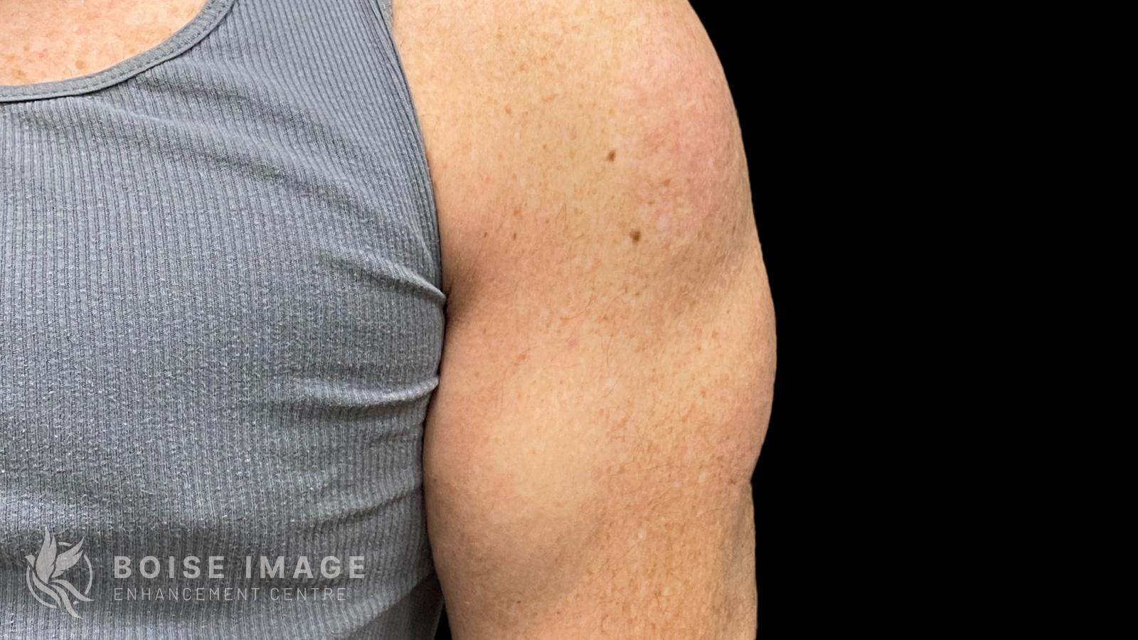 Boise Image Enhancement Center, Inc liposuction after — Boise, ID