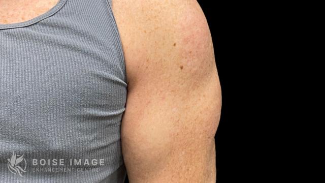 Liposuction after at Boise Image Enhancement Center, Inc in Boise, ID