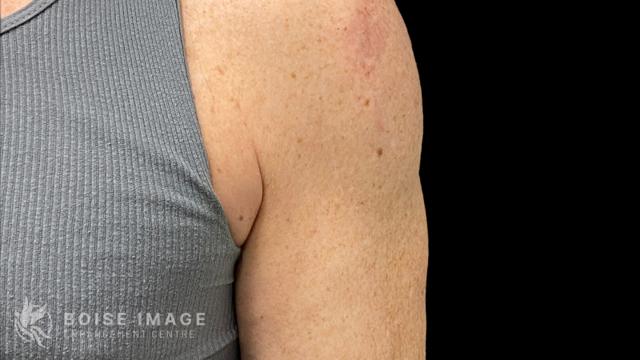 Liposuction before at Boise Image Enhancement Center, Inc in Boise, ID