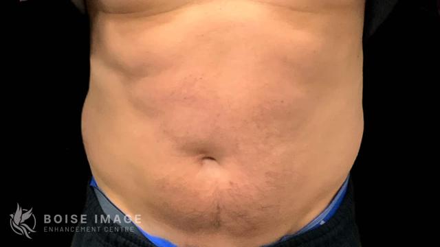 Liposuction after at Boise Image Enhancement Center, Inc in Boise, ID