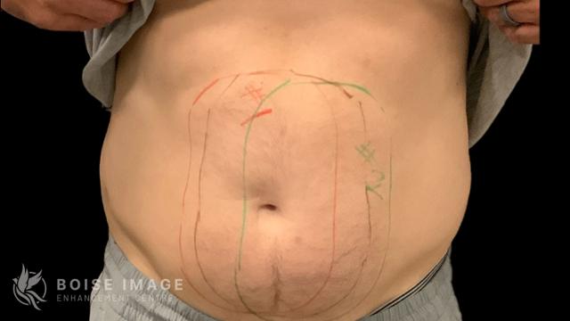 Liposuction before at Boise Image Enhancement Center, Inc in Boise, ID